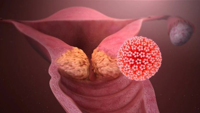 Cancer du col de l&rsquo;utérus : l&rsquo;immunothérapie associée à la chimioradiothérapie réduit le risque d&rsquo;aggravation de 30 %.