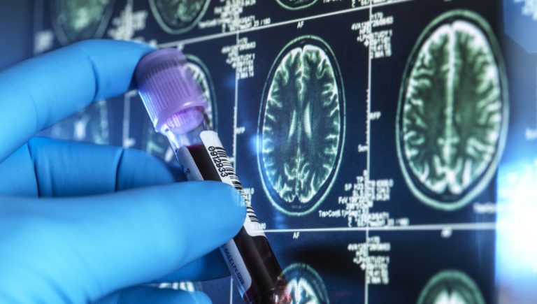 Cholestérol, triglycérides et démence : quel est le lien ?
