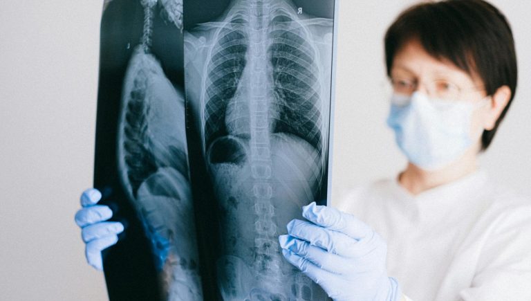 Cancer du poumon : l'Europe autorise l'immunothérapie avant et après une intervention chirurgicale