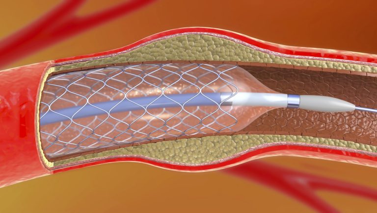 Le stent « ange gardien » contrôlera les artères coronaires et aidera à prévenir les crises cardiaques