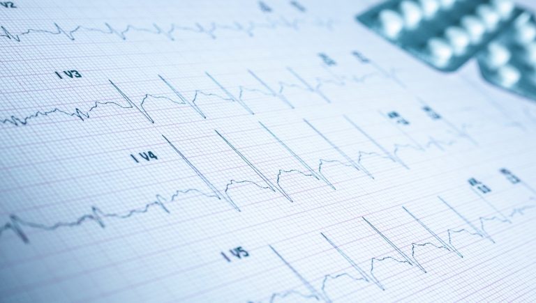 Polyarthrite rhumatoïde, crise cardiaque et accident vasculaire cérébral : les six marqueurs qui indiquent un risque plus élevé