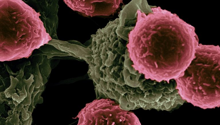Tumeur et zona vont de pair, avec le cancer, le risque d&rsquo;infection augmente