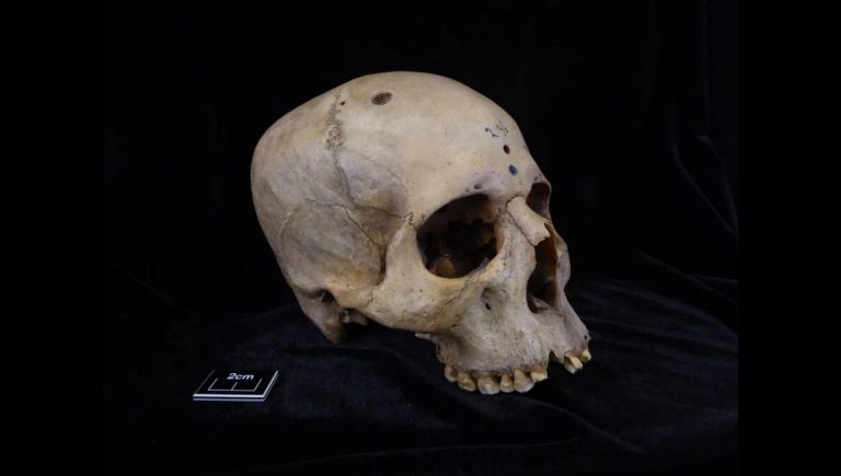 Egypte ancienne, un crâne d'il y a 4000 ans raconte comment était pratiquée la chirurgie anticancéreuse