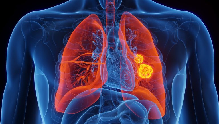 Cancer du poumon, feu vert européen à une thérapie ciblée pour réduire le risque de récidive de la maladie