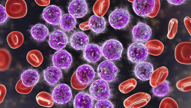 Leucémie myéloïde chronique, résultats prometteurs d’un nouveau médicament