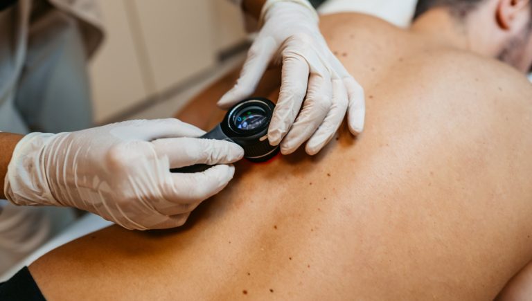 Mélanome : l’immunothérapie avant la chirurgie fonctionne
