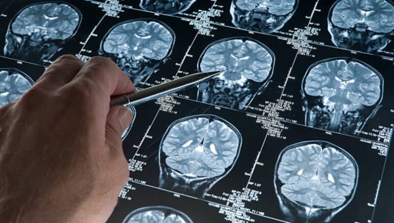 Stimulation magnétique transcrânienne pour lutter contre l&rsquo;anxiété