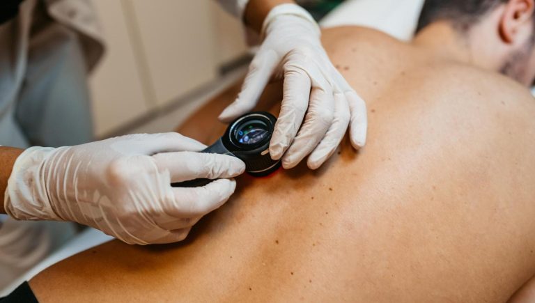 Mélanome, avec immunothérapie, la moitié des patients sont en vie à dix ans