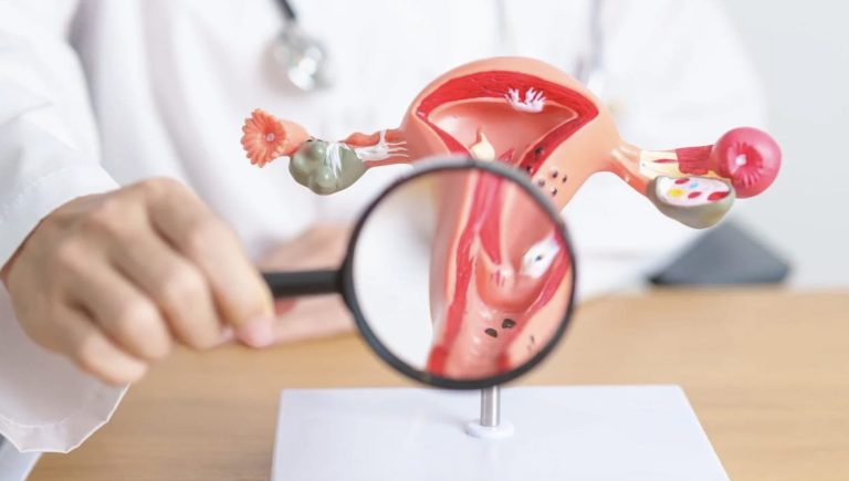 Tumeurs gynécologiques : « L’avenir réside dans les thérapies combinées pour sauver les femmes aux premiers stades de la maladie »