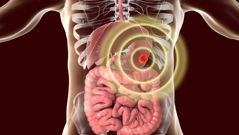Cancer de l&rsquo;estomac, quand un diagnostic précoce fait la différence
