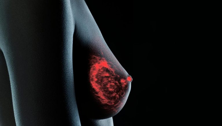 Cancer du sein métastatique, biopsie liquide pour intercepter la résistance