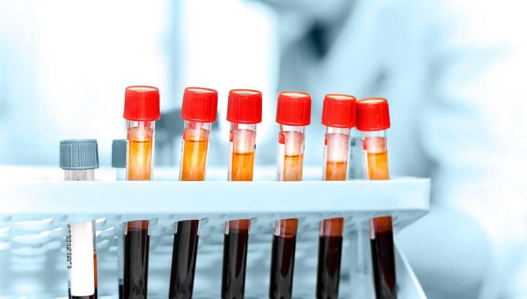 Cancer du côlon, comment utiliser la biopsie liquide pour personnaliser le traitement