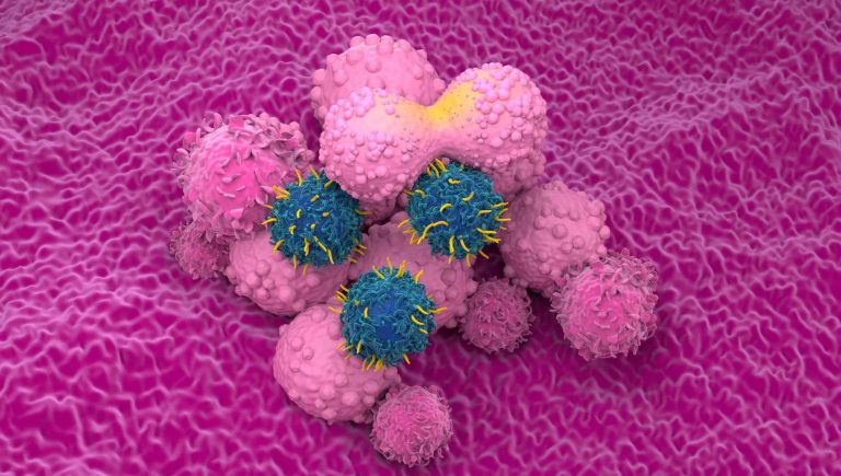 Car-T pour le cancer du sein : où en est la recherche ?