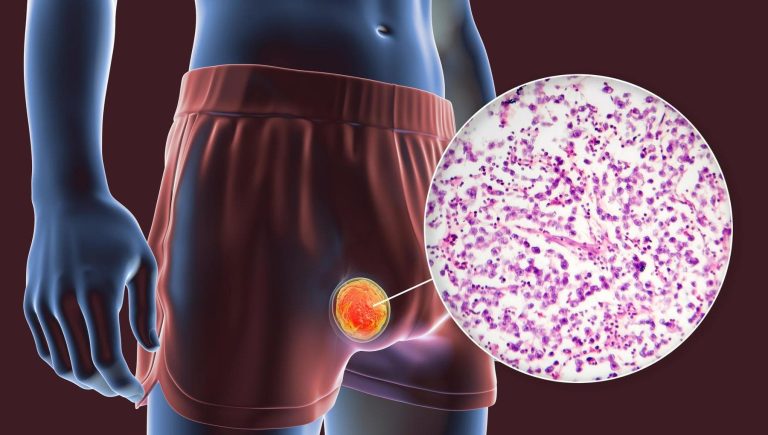 Tumeur du testicule, la prévention se touche. Éhonté