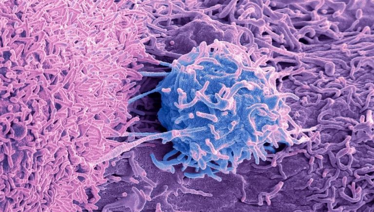 Cancer de la prostate, le nouveau remède qui bloque les métastases
