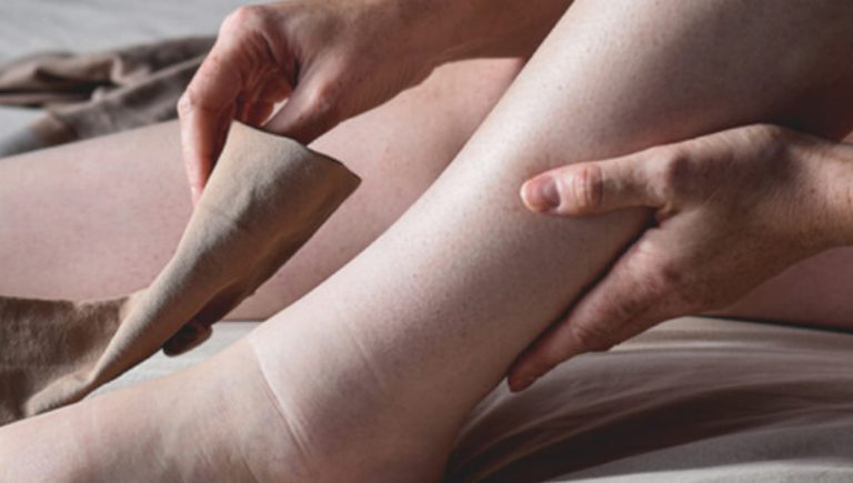 Journée mondiale des lympedema, chaque année 40 000 nouveaux cas en Italie