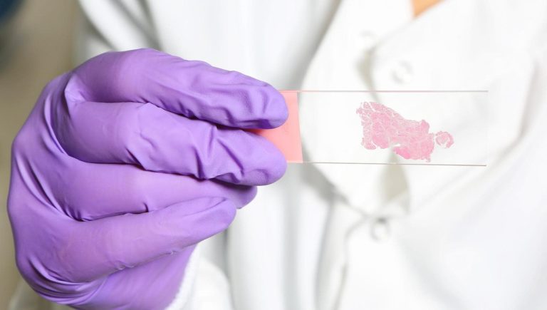 Cancer du sein, le chapeau -Trick qui allonge la vie