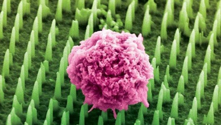 Tumeurs, un « patch » avec Nanoagi pour une analyse en temps réel. Même sans biopsie