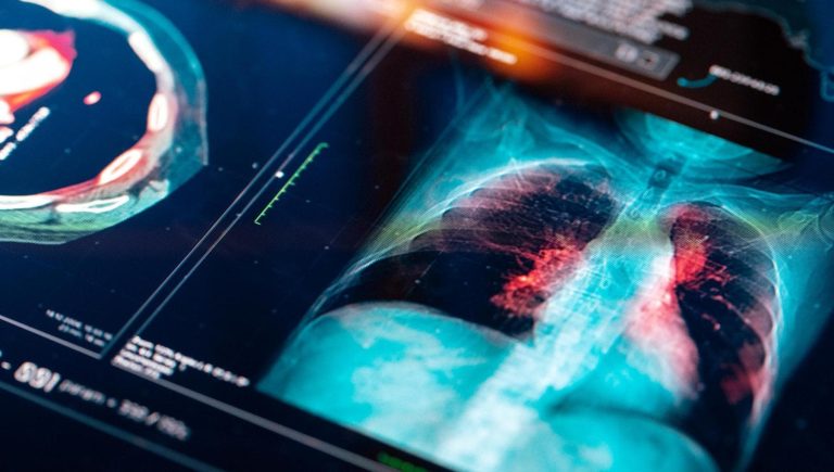 Cancer du poumon: du « grand tueur » à la médecine de précision