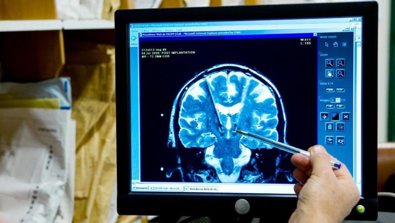 Hypertension résistante, la nouvelle hypothèse: si elle est née (aussi) dans le cerveau?