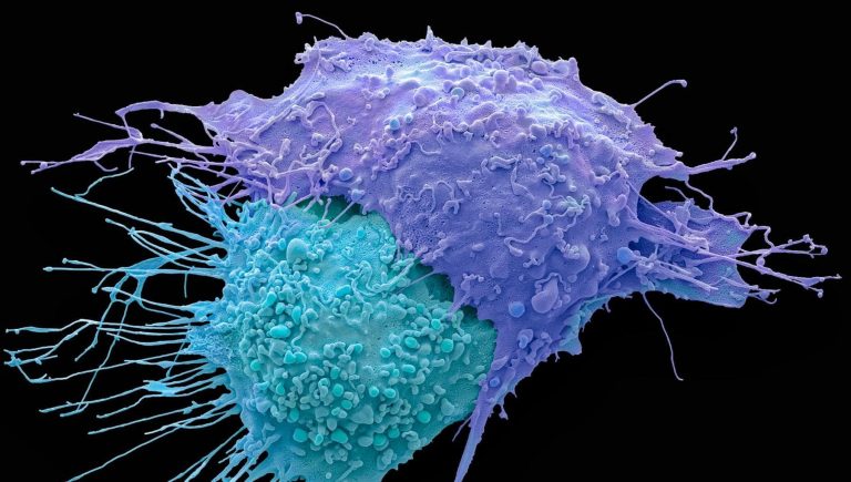 Cancer de l&rsquo;ovaire résistant au platine : des données encourageantes de l&rsquo;immunothérapie