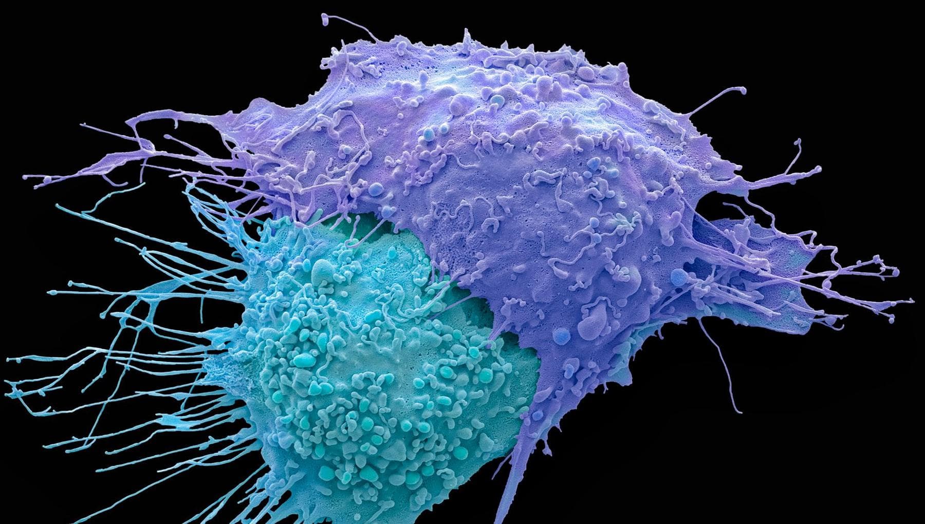 Cancer de l'ovaire résistant au platine : des données encourageantes de l'immunothérapie