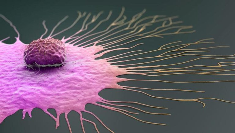 Esmo, cancer du sein triple négatif : la survie augmente grâce aux anticorps conjugués à un médicament