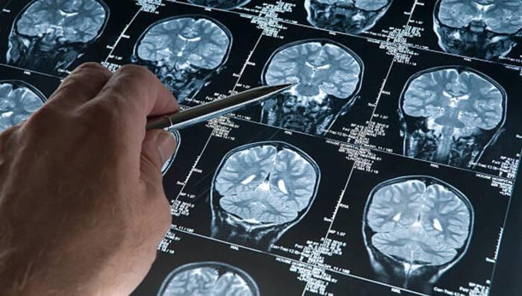 Glioblastome : causes, symptômes et traitements