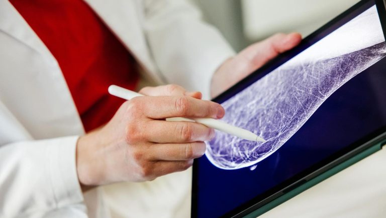 Cancer du sein avancé, une nouvelle thérapie réduit de moitié le risque de progression