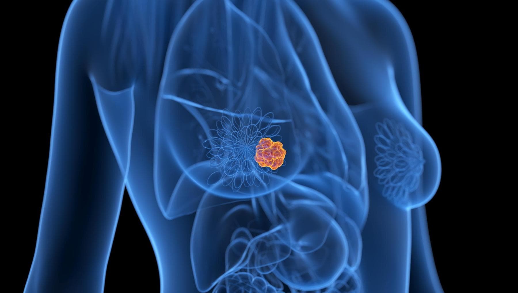 Cancer du sein, un nouveau médicament réduit le risque de récidive de la maladie