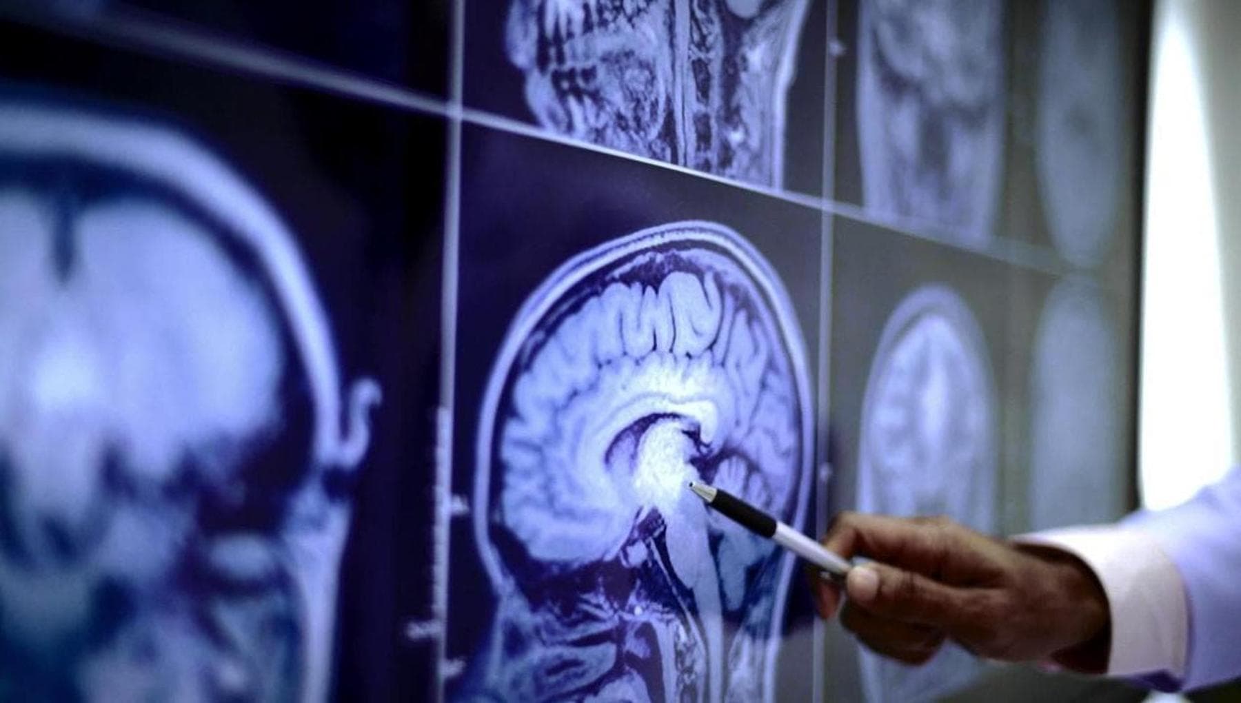 AVC, comment y faire face au mieux à tout âge