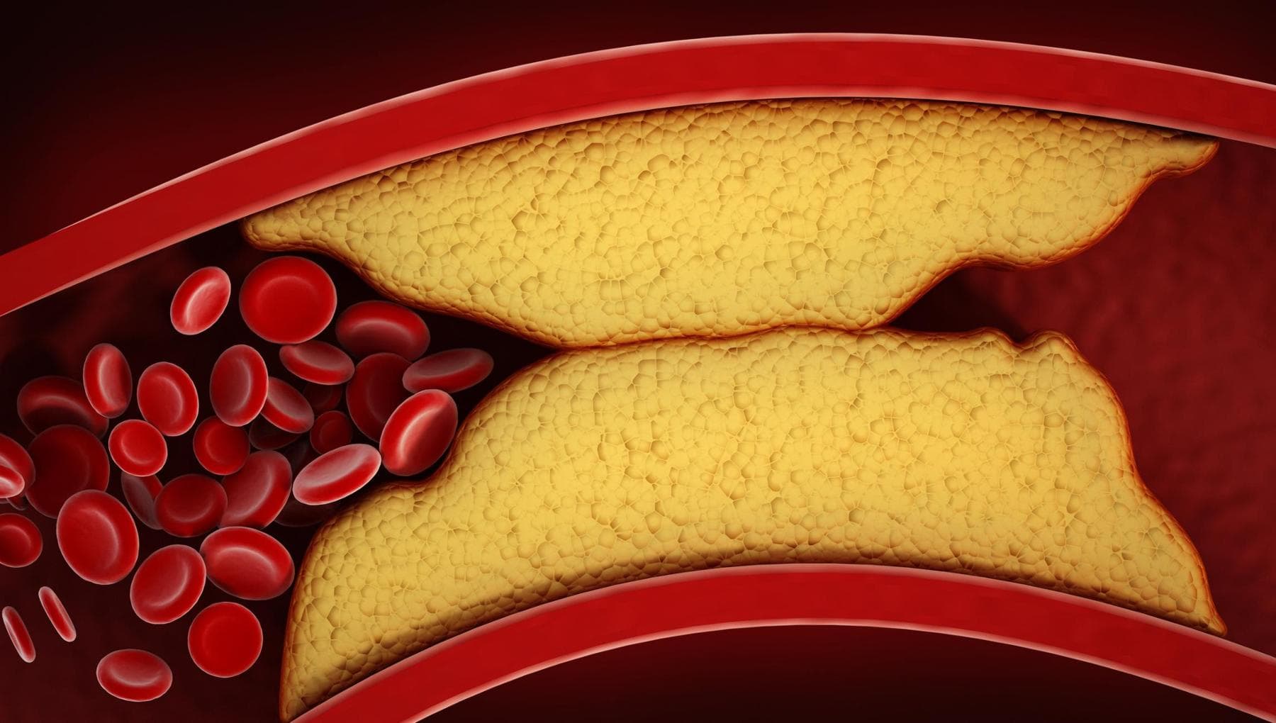 Cholestérol LDL, la phobie des statines n'a aucun sens : les bénéfices l'emportent sur les risques