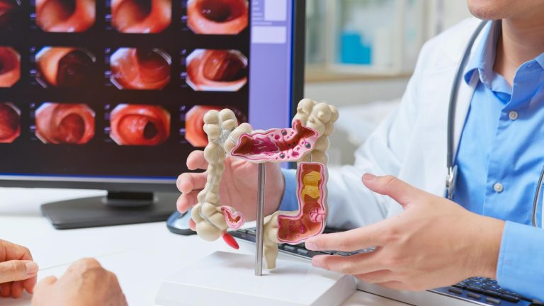 Cancer du côlon, l&rsquo;importance des tests moléculaires pour le cibler de manière ciblée