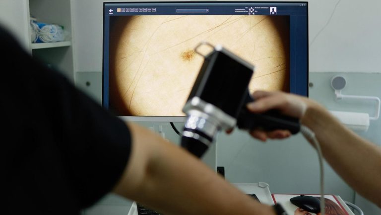 Le mélanome, qu'est-ce que c'est, comment ça se passe, facteurs de risque


