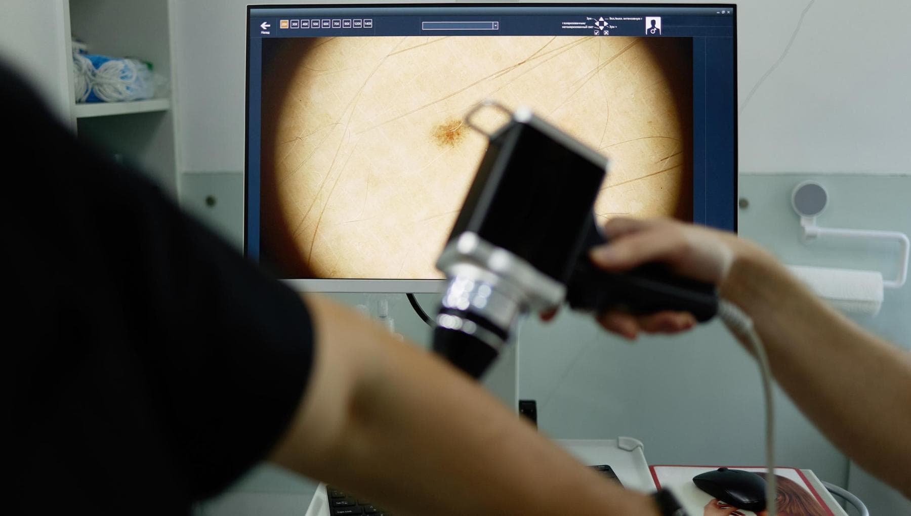 Le mélanome, qu'est-ce que c'est, comment ça se passe, facteurs de risque