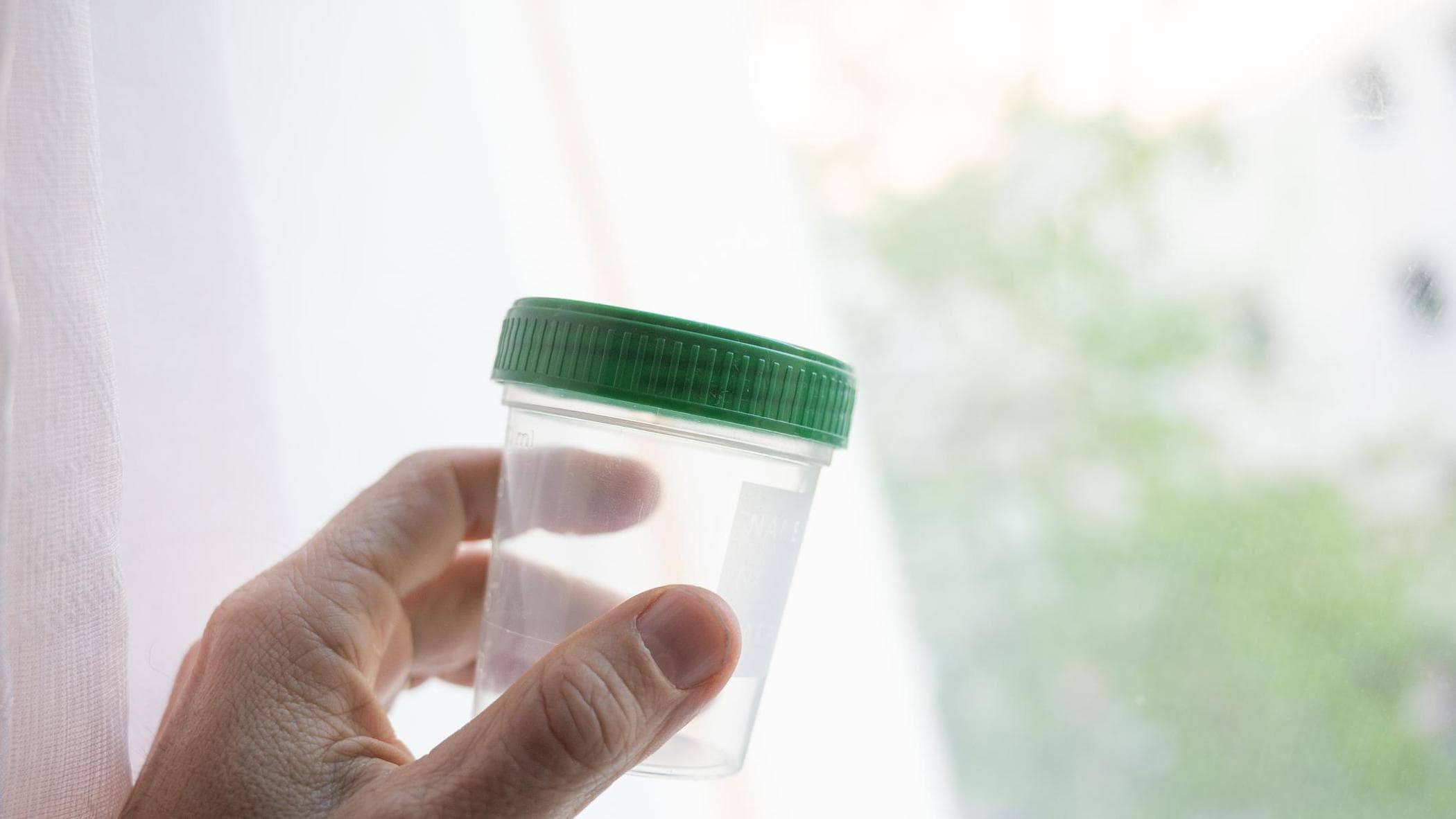 Cancer de la prostate, moins de biopsies de contrôle avec un nouveau test d'urine