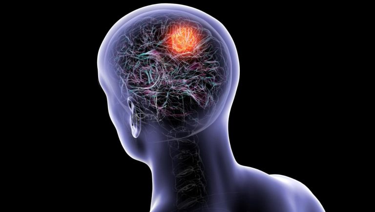 Le glioblastome, chez les hommes, la testostérone semble ralentir la maladie