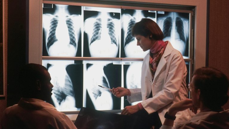 Cancer du poumon, la « signature » dans le sang qui prédit le risque 5 ans avant le diagnostic