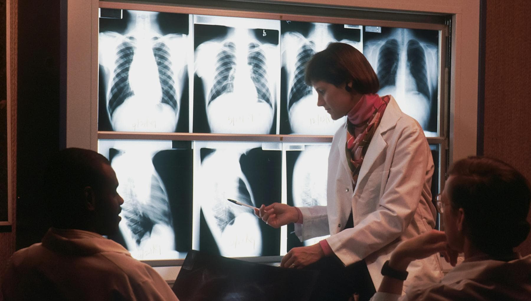 Cancer du poumon, la « signature » dans le sang qui prédit le risque 5 ans avant le diagnostic