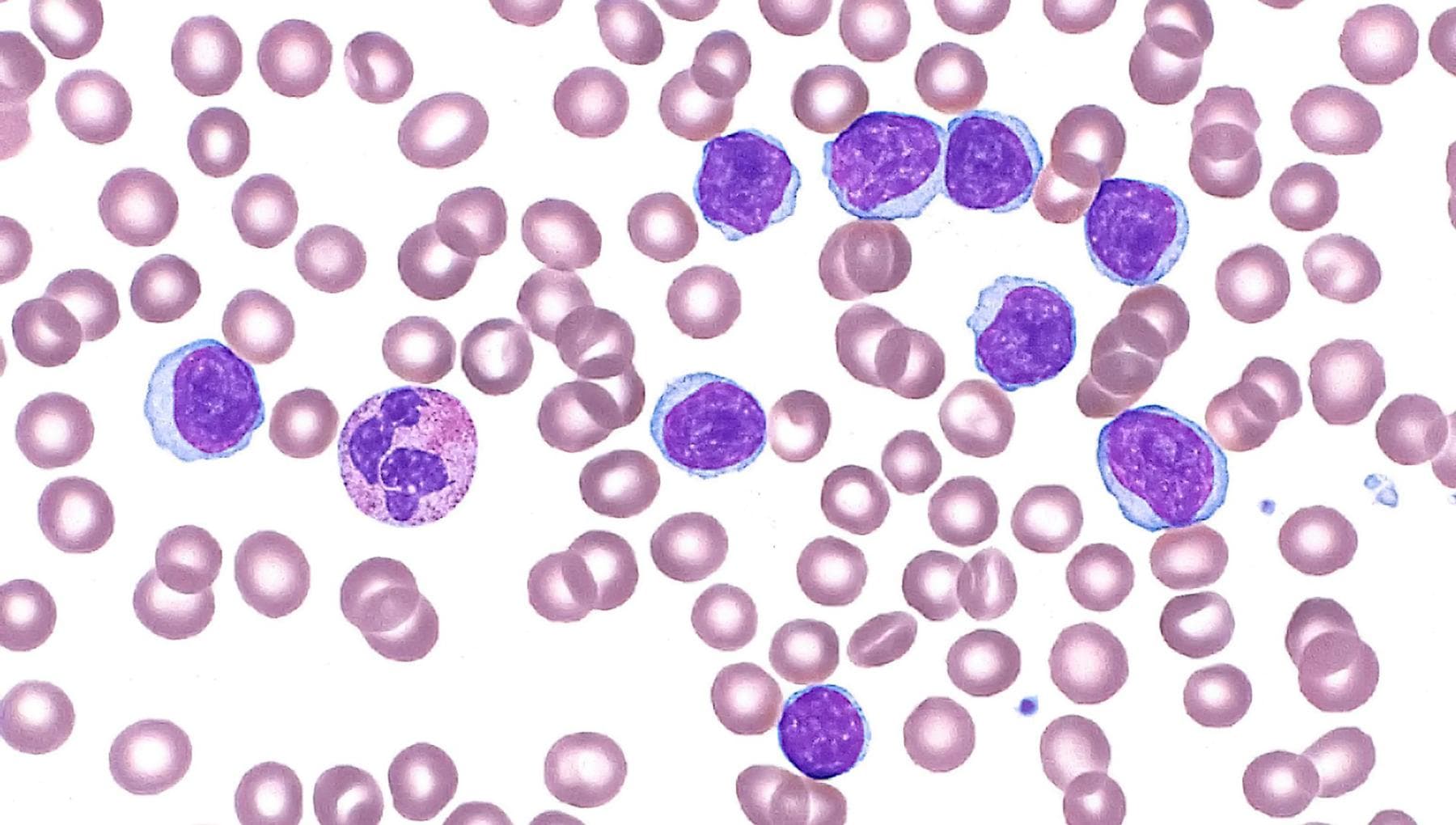 Leucémie lymphoïde chronique, des bénéfices durables chez les patients âgés