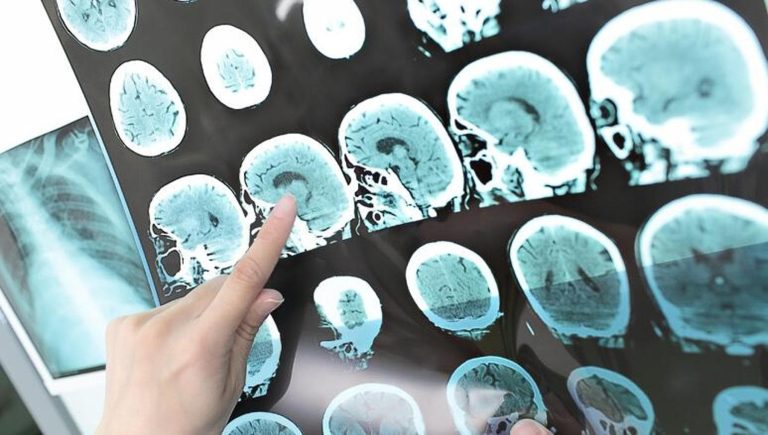 AVC lacunaire, voici comment il endommage le cerveau : comment il survient et comment le prévenir