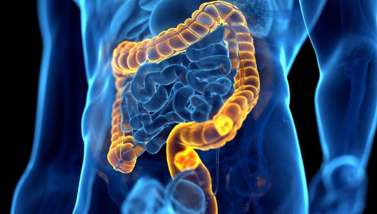Cancer colorectal, quelle est l'efficacité des dépistages ?


