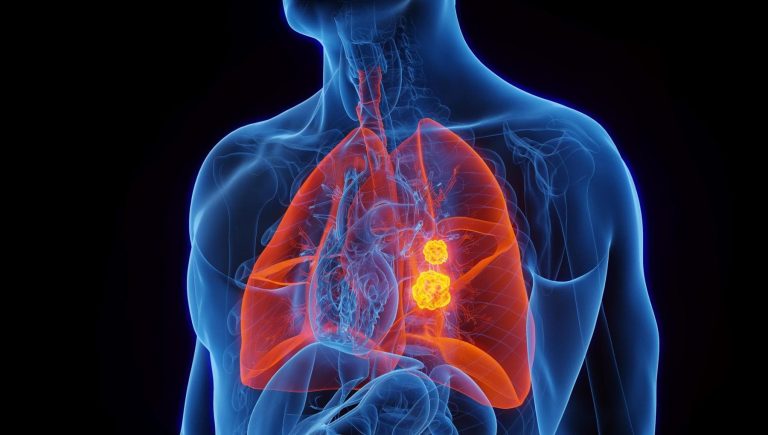 Cancer du poumon : les patients plus jeunes présentent davantage de mutations traitables


