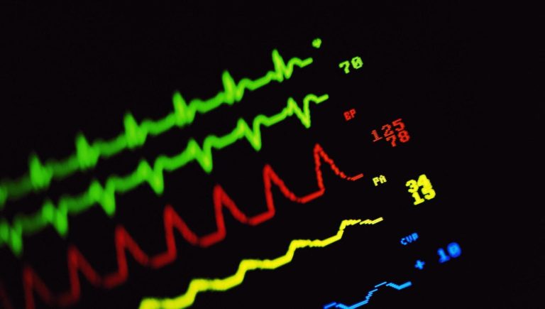 Fibrillation auriculaire, en voici la preuve : ceux qui la traitent bien ralentissent la maladie d'Alzheimer


