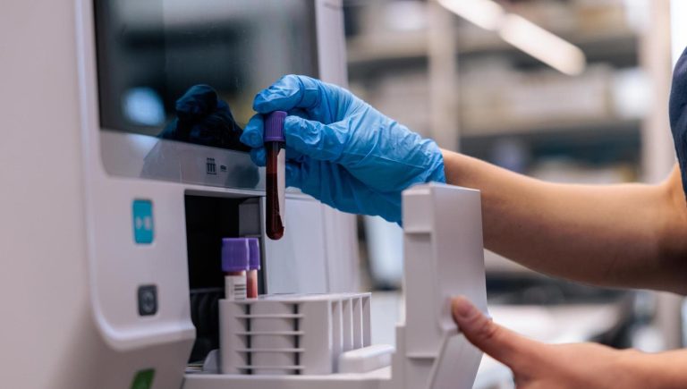 Cancer du pancréas : une nouvelle prise de sang permettra de le détecter plus tôt


