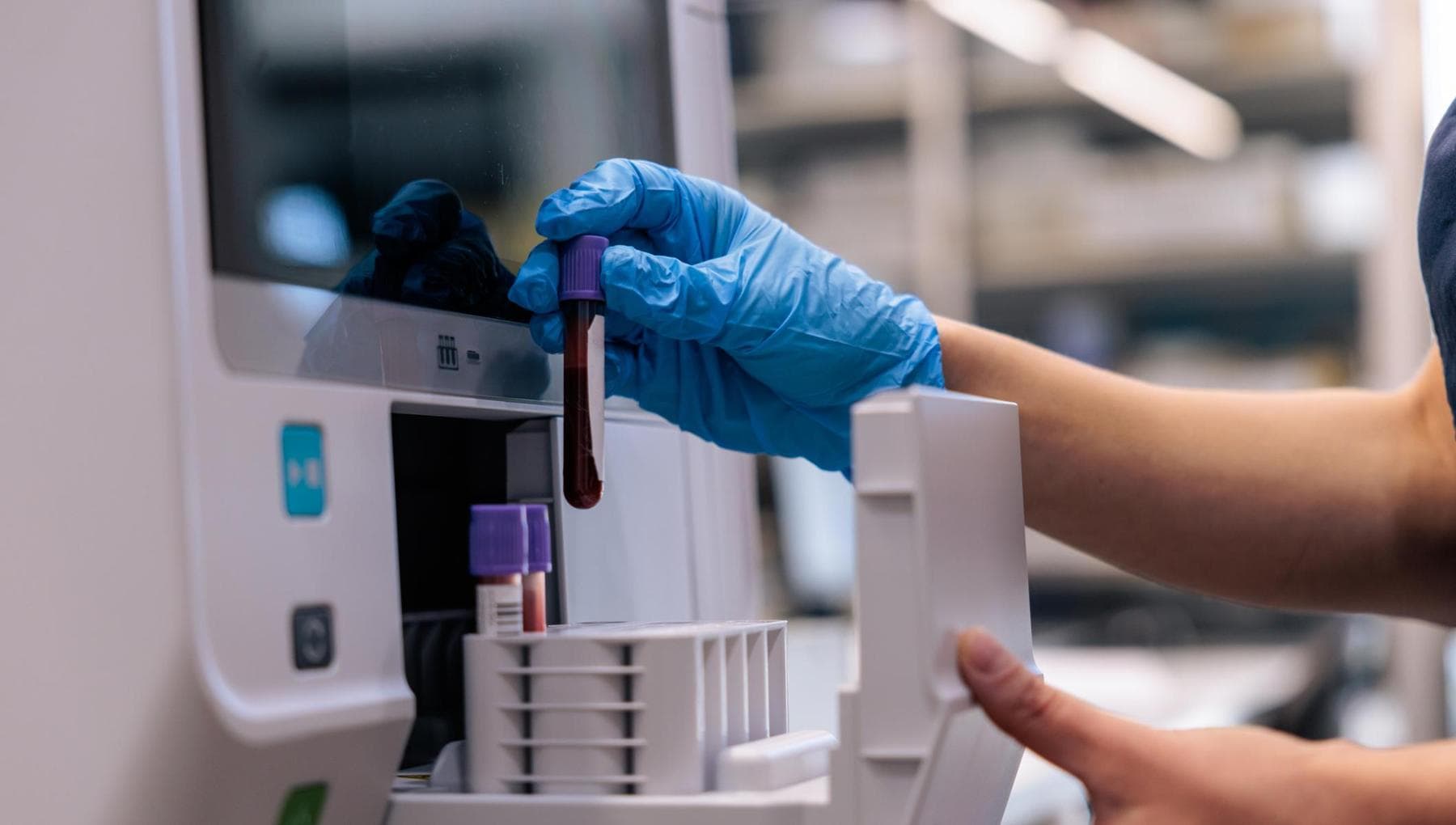 Cancer du pancréas : une nouvelle prise de sang permettra de le détecter plus tôt