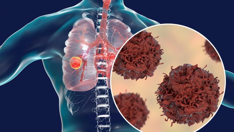 Cancer du poumon avec mutation HER2 : nouvelle option thérapeutique possible de première ligne


