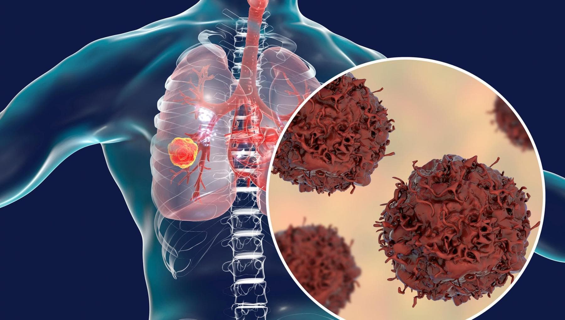 Cancer du poumon avec mutation HER2 : nouvelle option thérapeutique possible de première ligne
