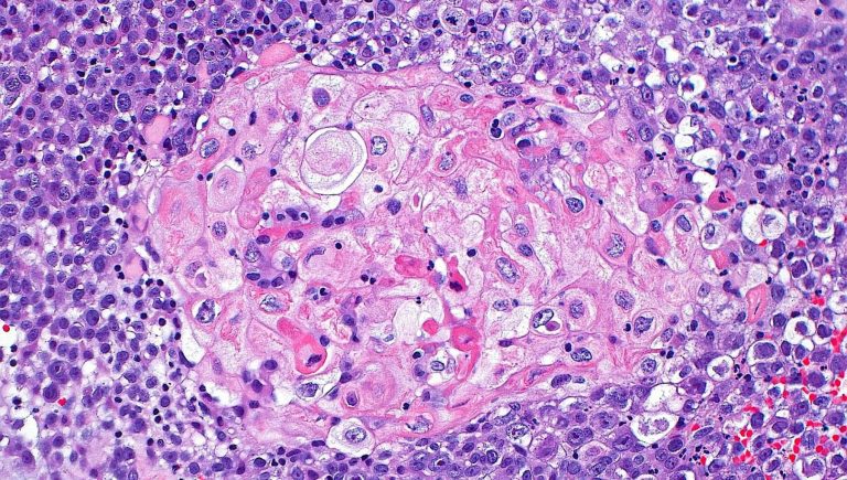 Cancer de la vessie opérable, une nouvelle option thérapeutique arrive


