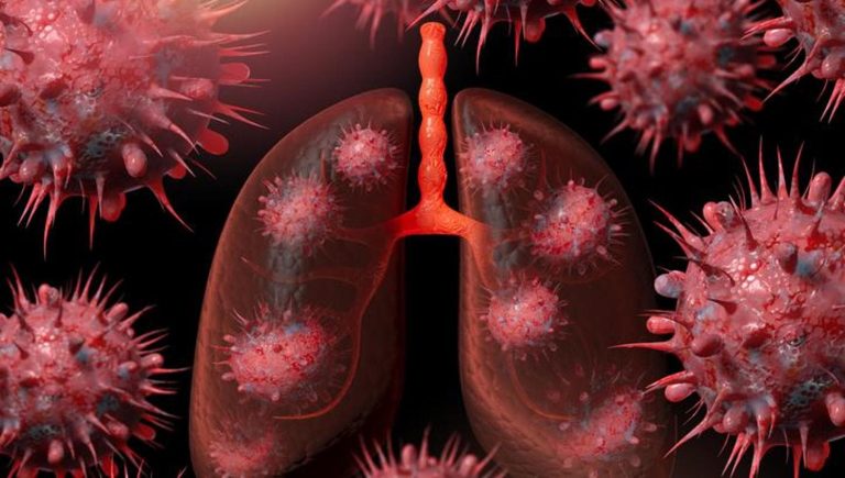 Cancer du poumon, un vaccin expérimental augmente la survie jusqu'à 47 %


